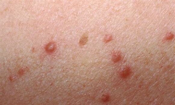 L'apparition de papillomes sur la peau des femmes